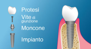 impianto-titanio-dental-piu-sarzana-marina-di-massa