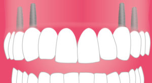 protesi-fissa-dental-piu-homea-sarzana-marina-di-massa