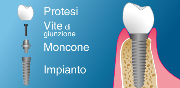 Implantologia, protesi mobile, carico immediato - Dental Più