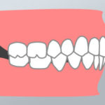 Malocclusione di Prima Classe - Dental Più