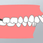 Malocclusione di Prima Classe - Dental Più