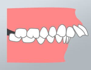 malocclusione-2-classe-dental-piu