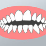 Ortodonzia Morso Aperto - Dental Più