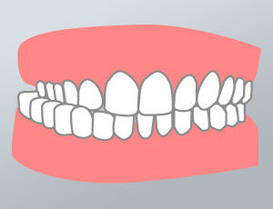 morso-incrociato-dental-piu