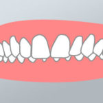 Ortodonzia Morso Profondo - Dental Più