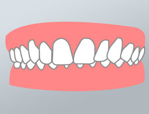 morso-profondo-dental-piu